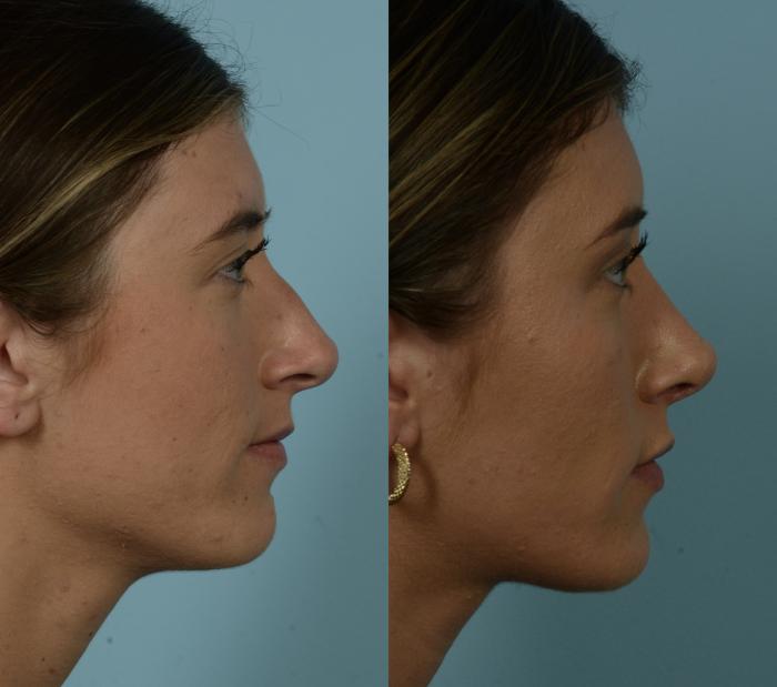 Before & After Rhinoplasty by Dr. Mustoe Case 965 Right Side View in Chicago, IL