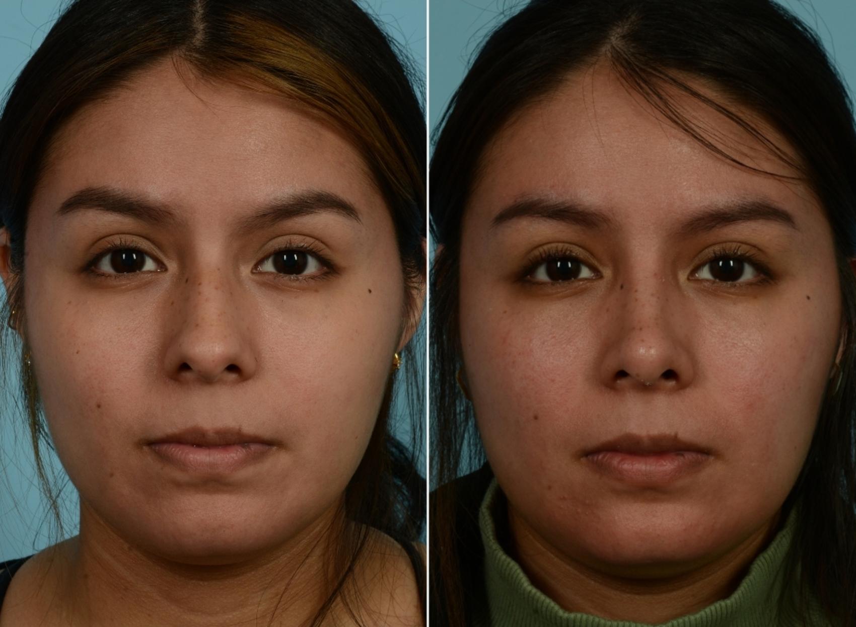Before & After Rhinoplasty by Dr. Mustoe Case 972 Front View in Chicago, IL