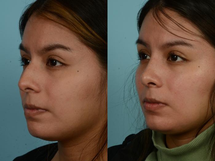 Before & After Rhinoplasty by Dr. Mustoe Case 972 Left Oblique View in Chicago, IL
