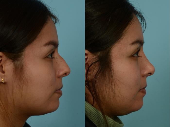 Before & After Rhinoplasty by Dr. Mustoe Case 972 Right Side View in Chicago, IL