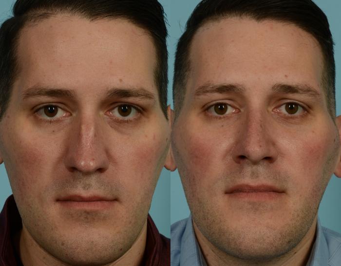 Before & After Rhinoplasty by Dr. Mustoe Case 976 Front View in Chicago, IL