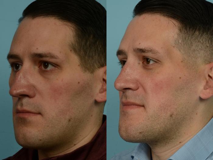 Before & After Rhinoplasty by Dr. Mustoe Case 976 Left Oblique View in Chicago, IL