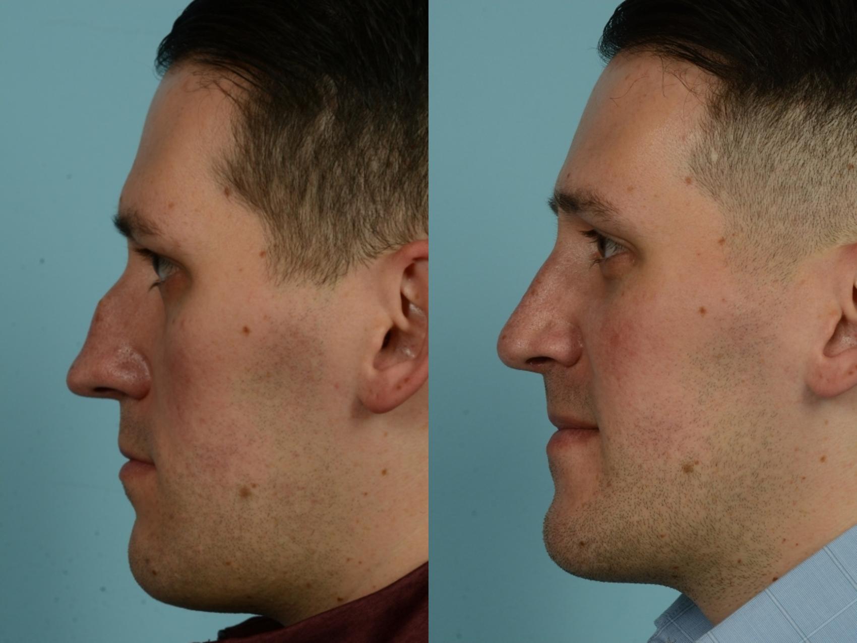 Before & After Rhinoplasty by Dr. Mustoe Case 976 Left Side View in Chicago, IL