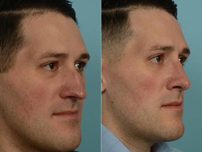 Before & After Rhinoplasty by Dr. Mustoe Case 976 Right Oblique View in Chicago, IL