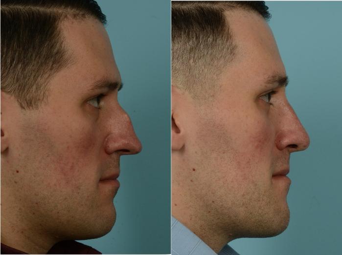 Before & After Rhinoplasty by Dr. Mustoe Case 976 Right Side View in Chicago, IL