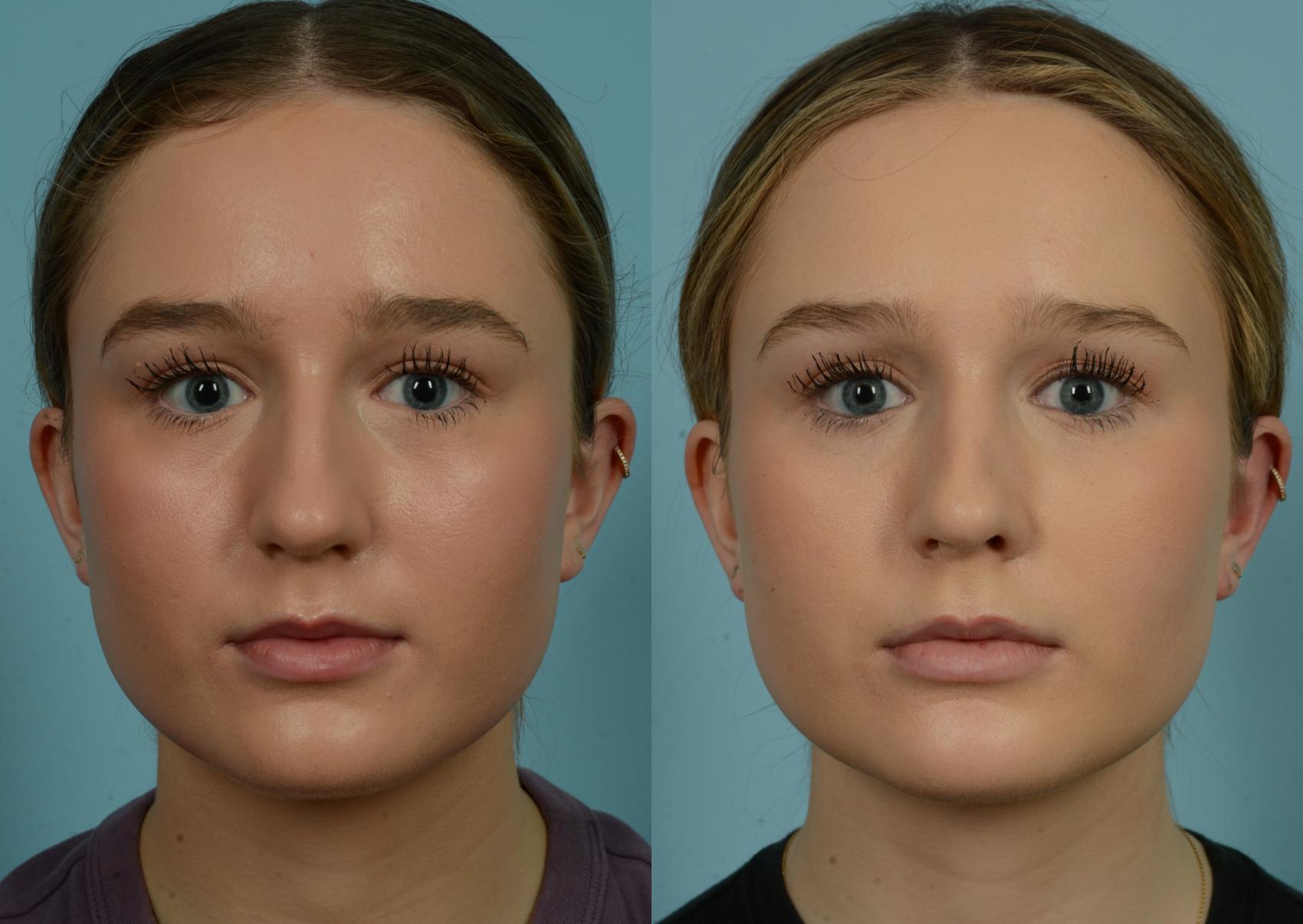 Before & After Rhinoplasty by Dr. Mustoe Case 981 Front View in Chicago, IL