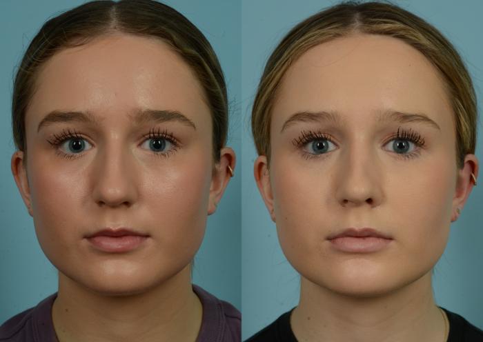 Before & After Rhinoplasty by Dr. Mustoe Case 981 Front View in Chicago, IL