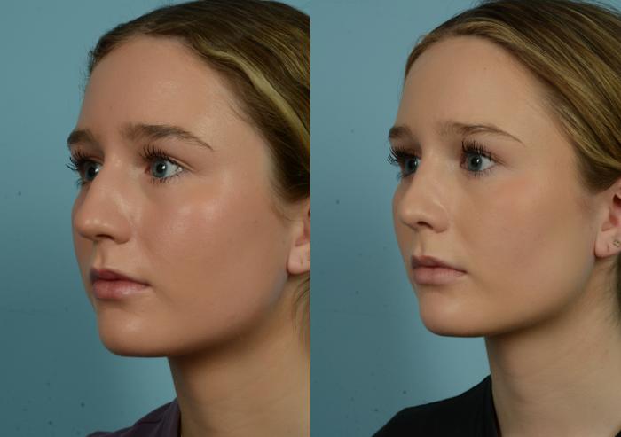 Before & After Rhinoplasty by Dr. Mustoe Case 981 Left Oblique View in Chicago, IL