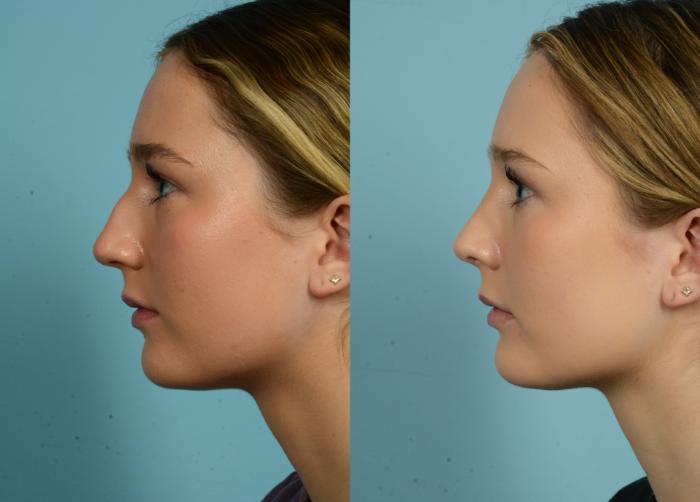 Before & After Rhinoplasty by Dr. Mustoe Case 981 Left Side View in Chicago, IL