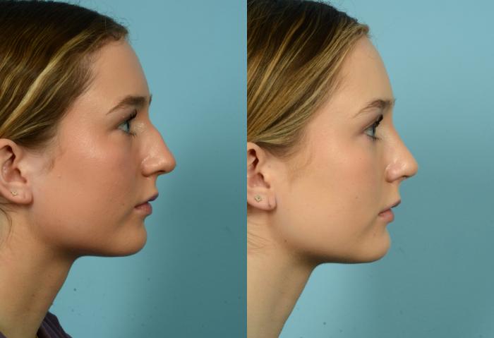 Before & After Rhinoplasty by Dr. Mustoe Case 981 Right Side View in Chicago, IL