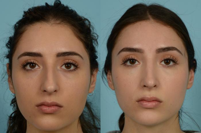 Before & After Rhinoplasty by Dr. Mustoe Case 989 Front View in Chicago, IL