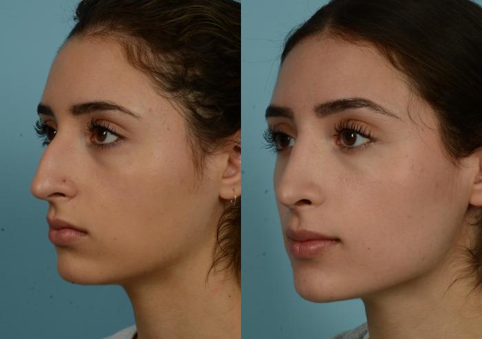 Before & After Rhinoplasty by Dr. Mustoe Case 989 Left Oblique View in Chicago, IL