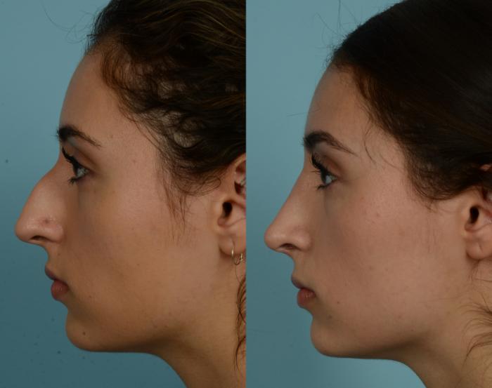 Before & After Rhinoplasty by Dr. Mustoe Case 989 Left Side View in Chicago, IL