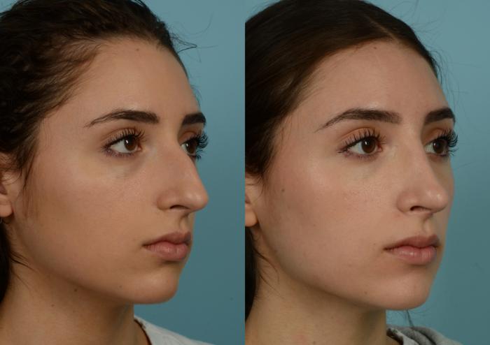 Before & After Rhinoplasty by Dr. Mustoe Case 989 Right Oblique View in Chicago, IL