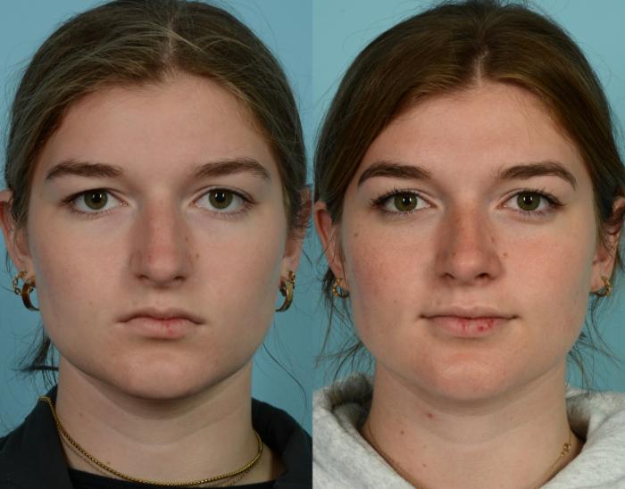 Before & After Rhinoplasty by Dr. Mustoe Case 990 Front View in Chicago, IL