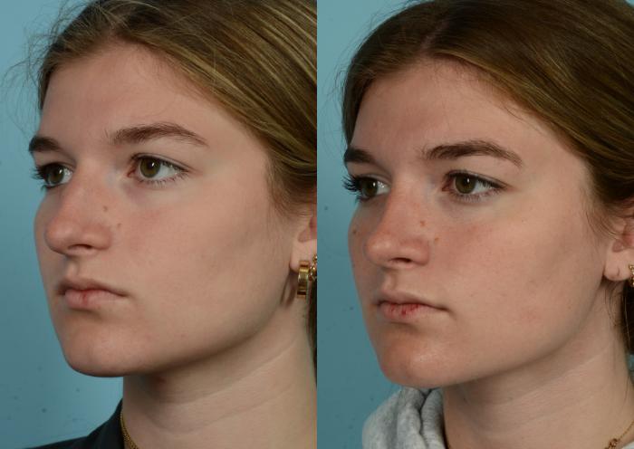 Before & After Rhinoplasty by Dr. Mustoe Case 990 Left Oblique View in Chicago, IL