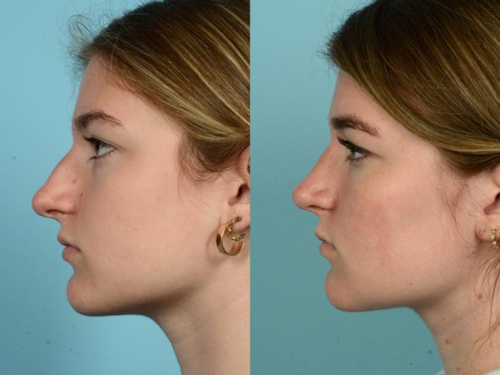 Before & After Rhinoplasty by Dr. Mustoe Case 990 Left Side View in Chicago, IL
