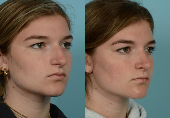 Before & After Rhinoplasty by Dr. Mustoe Case 990 Right Oblique View in Chicago, IL