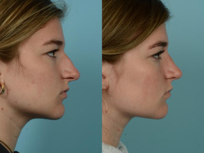 Before & After Rhinoplasty by Dr. Mustoe Case 990 Right Side View in Chicago, IL