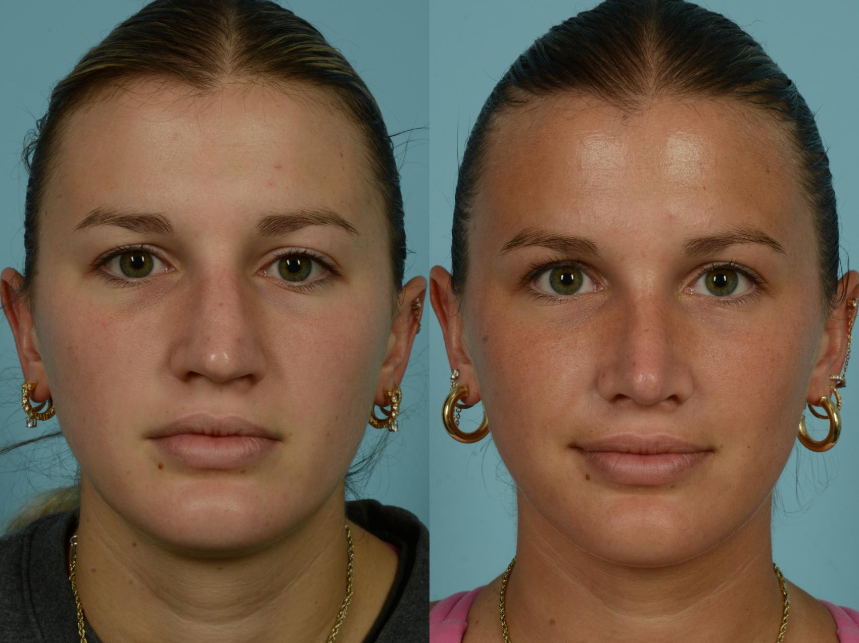 Before & After Rhinoplasty by Dr. Mustoe Case 994 Front View in Chicago, IL