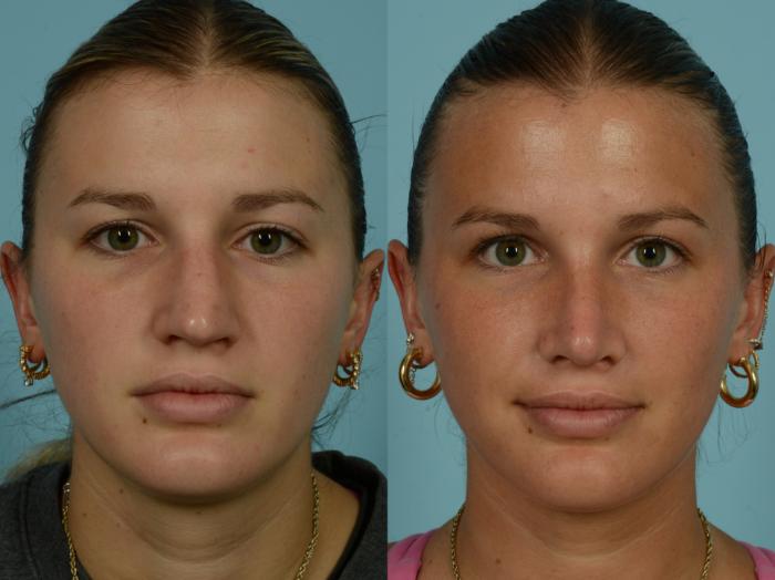 Before & After Rhinoplasty by Dr. Mustoe Case 994 Front View in Chicago, IL