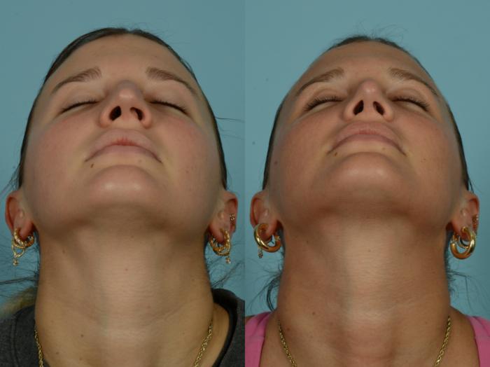 Before & After Rhinoplasty by Dr. Mustoe Case 994 Front Tilt View in Chicago, IL