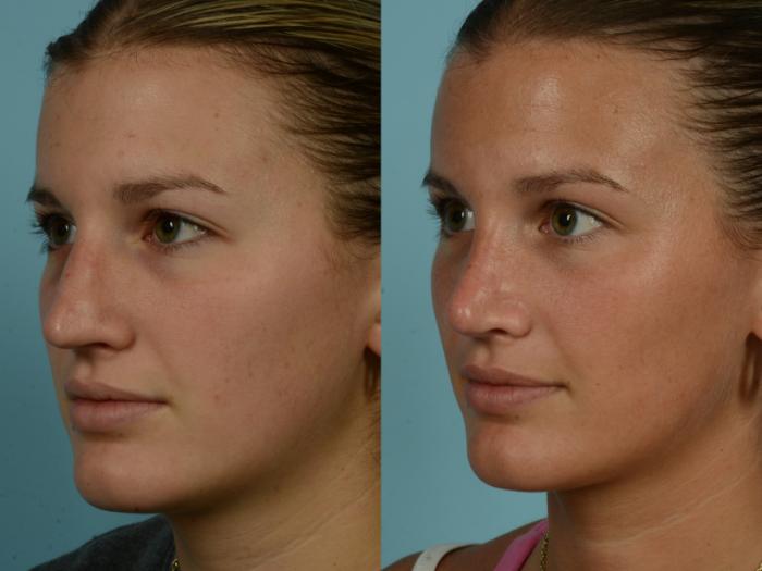 Before & After Rhinoplasty by Dr. Mustoe Case 994 Left Oblique View in Chicago, IL