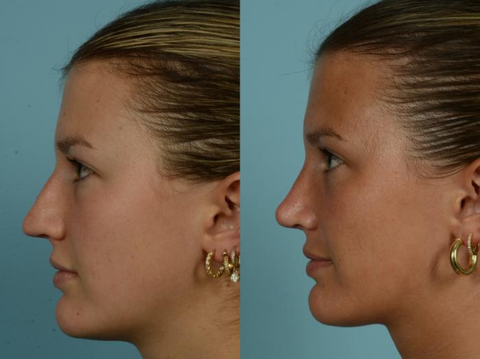 Before & After Rhinoplasty by Dr. Mustoe Case 994 Left Side View in Chicago, IL