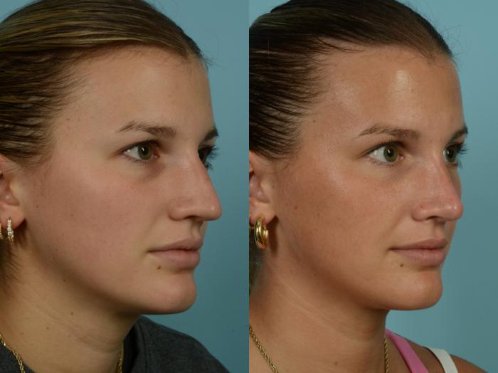 Before & After Rhinoplasty by Dr. Mustoe Case 994 Right Oblique View in Chicago, IL