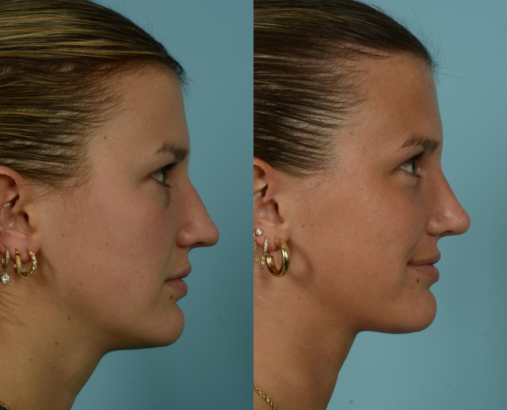Before & After Rhinoplasty by Dr. Mustoe Case 994 Right Side View in Chicago, IL
