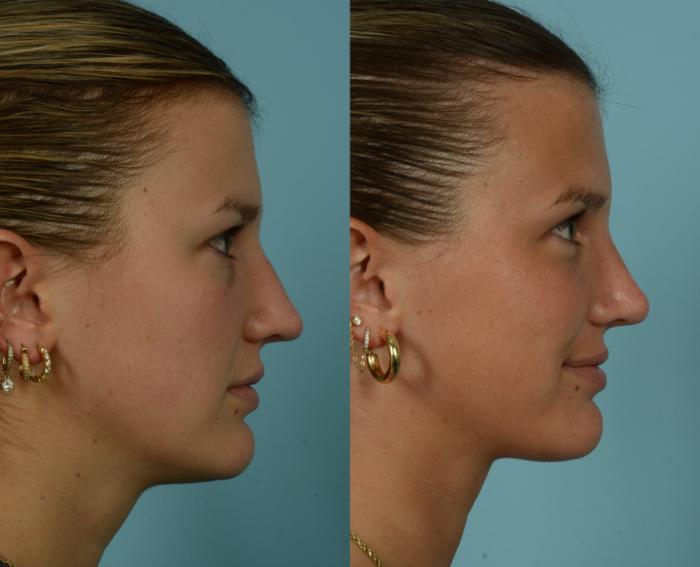 Before & After Rhinoplasty by Dr. Mustoe Case 994 Right Side View in Chicago, IL