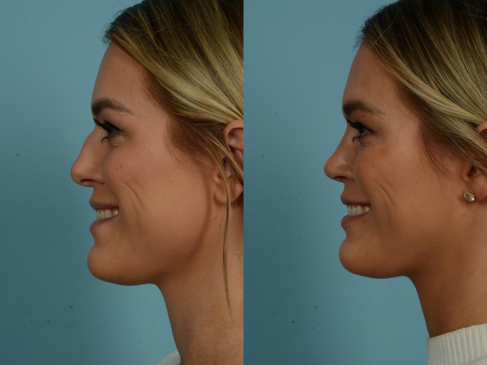 Before & After Rhinoplasty by Dr. Sinno Case 1006 Left Side View in Chicago, IL