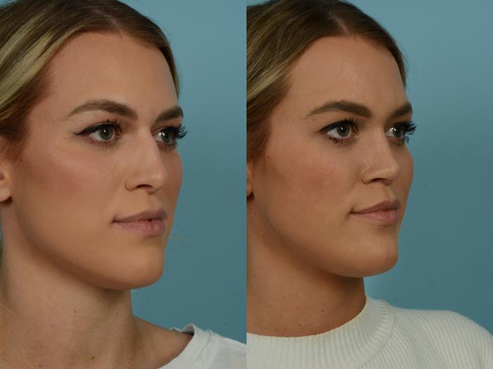 Before & After Rhinoplasty by Dr. Sinno Case 1006 Right Oblique View in Chicago, IL