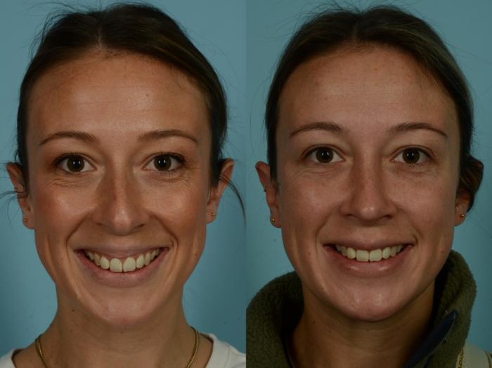 Before & After Rhinoplasty by Dr. Sinno Case 1014 Front View in Chicago, IL