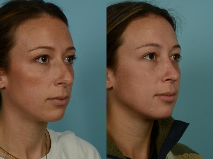 Before & After Rhinoplasty by Dr. Sinno Case 1014 Right Oblique View in Chicago, IL