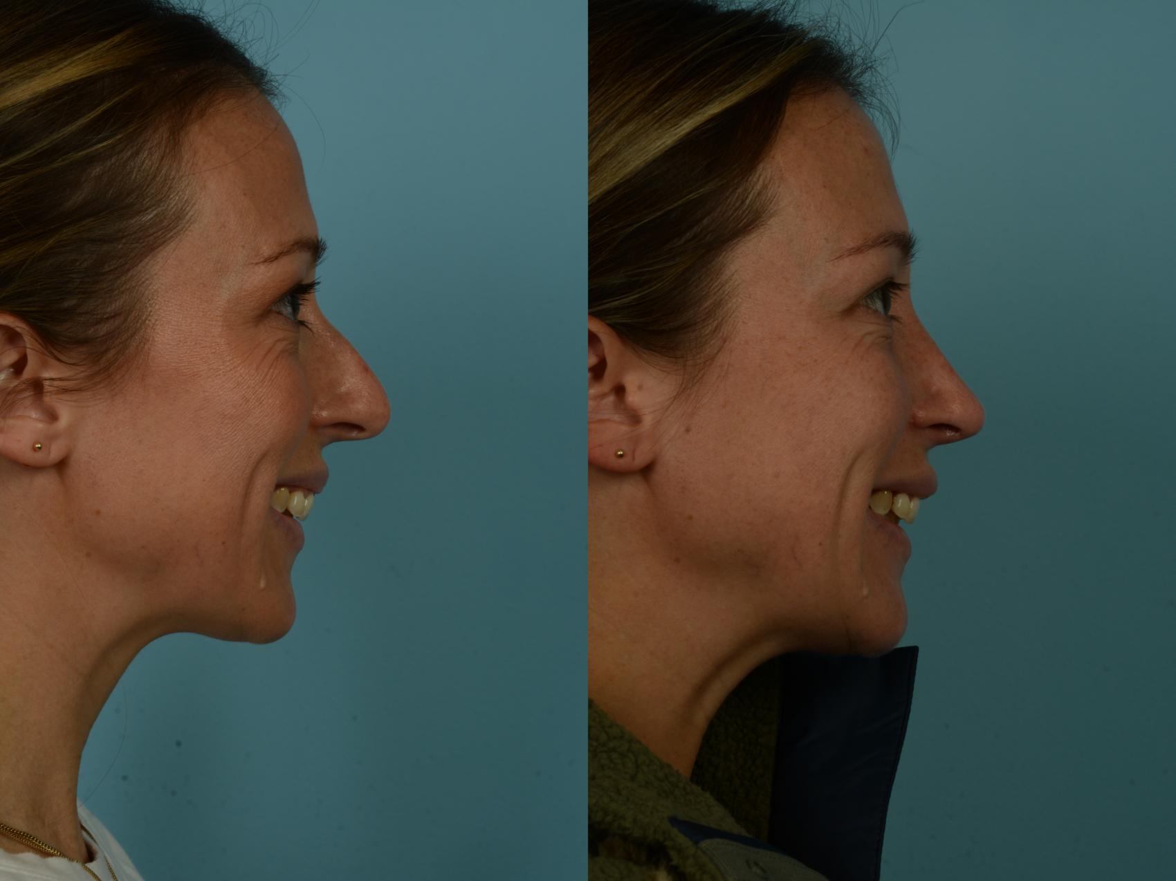 Before & After Rhinoplasty by Dr. Sinno Case 1014 Right Side View in Chicago, IL