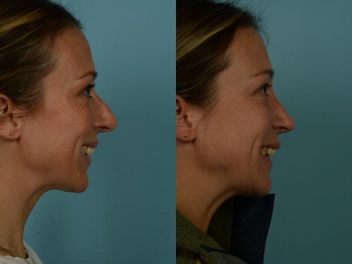 Before & After Rhinoplasty by Dr. Sinno Case 1014 Right Side View in Chicago, IL