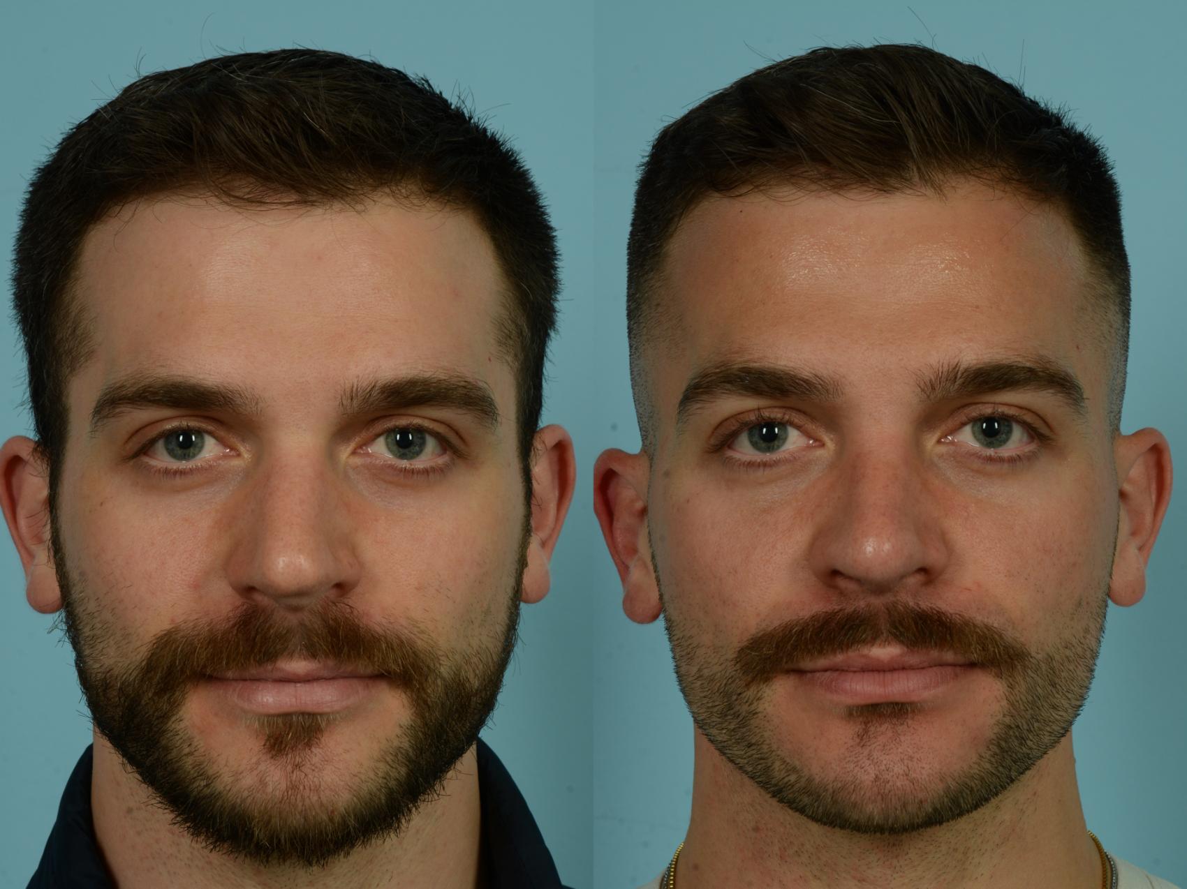 Before & After Rhinoplasty by Dr. Sinno Case 1021 Front View in Chicago, IL