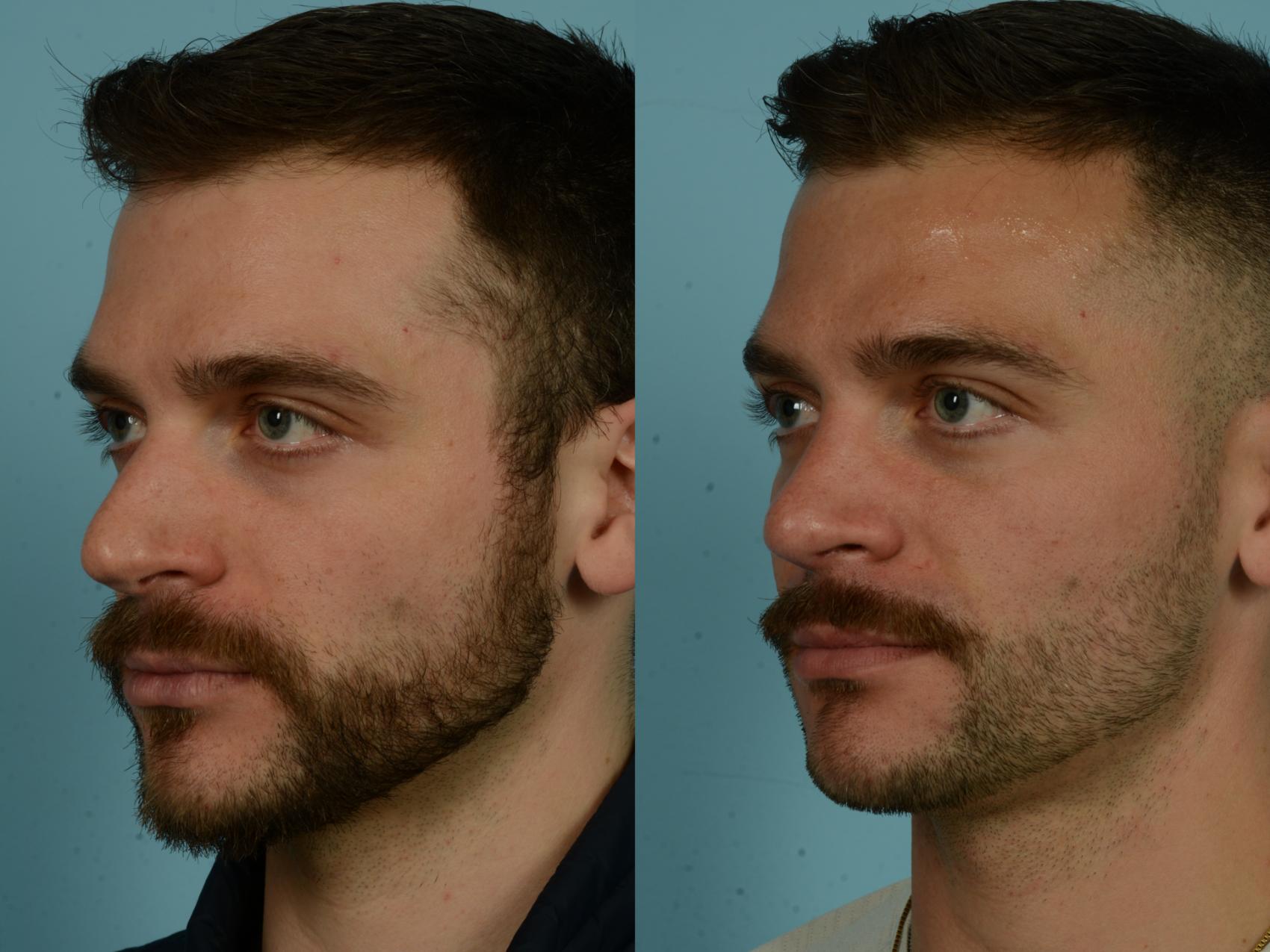 Before & After Rhinoplasty by Dr. Sinno Case 1021 Left Oblique View in Chicago, IL