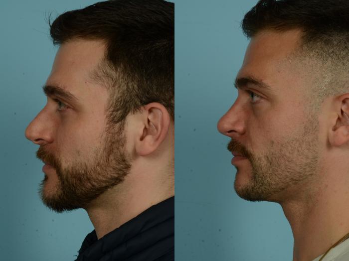 Before & After Rhinoplasty by Dr. Sinno Case 1021 Left Side View in Chicago, IL