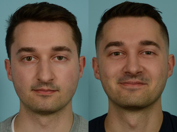 Before & After Rhinoplasty by Dr. Sinno Case 1026 Front View in Chicago, IL