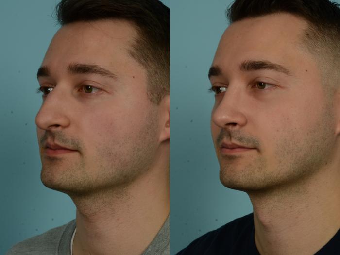 Before & After Rhinoplasty by Dr. Sinno Case 1026 Left Oblique View in Chicago, IL