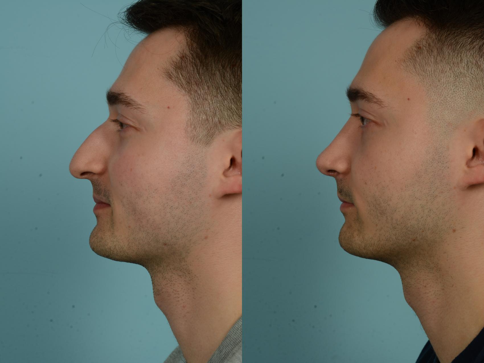 Before & After Rhinoplasty by Dr. Sinno Case 1026 Left Side View in Chicago, IL