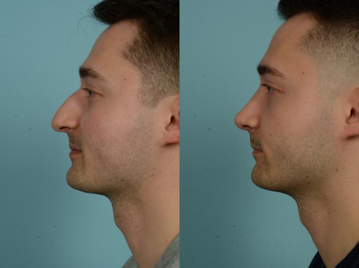 Before & After Rhinoplasty by Dr. Sinno Case 1026 Left Side View in Chicago, IL