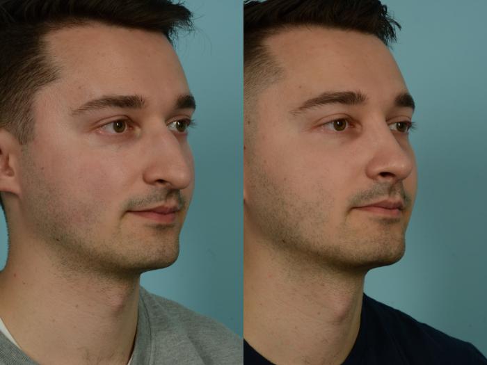 Before & After Rhinoplasty by Dr. Sinno Case 1026 Right Oblique View in Chicago, IL