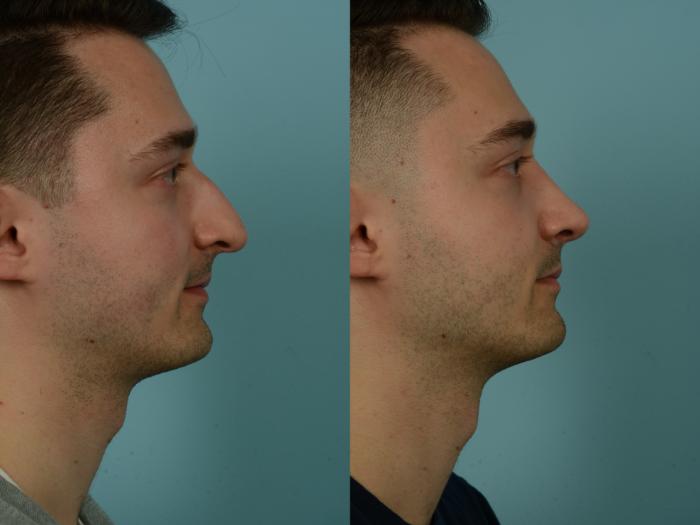 Before & After Rhinoplasty by Dr. Sinno Case 1026 Right Side View in Chicago, IL