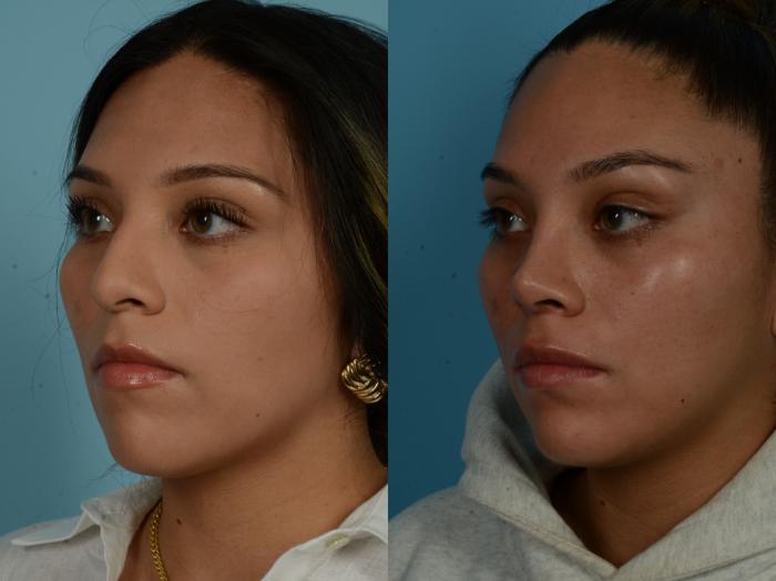 Before & After Rhinoplasty by Dr. Sinno Case 1027 Left Oblique View in Chicago, IL