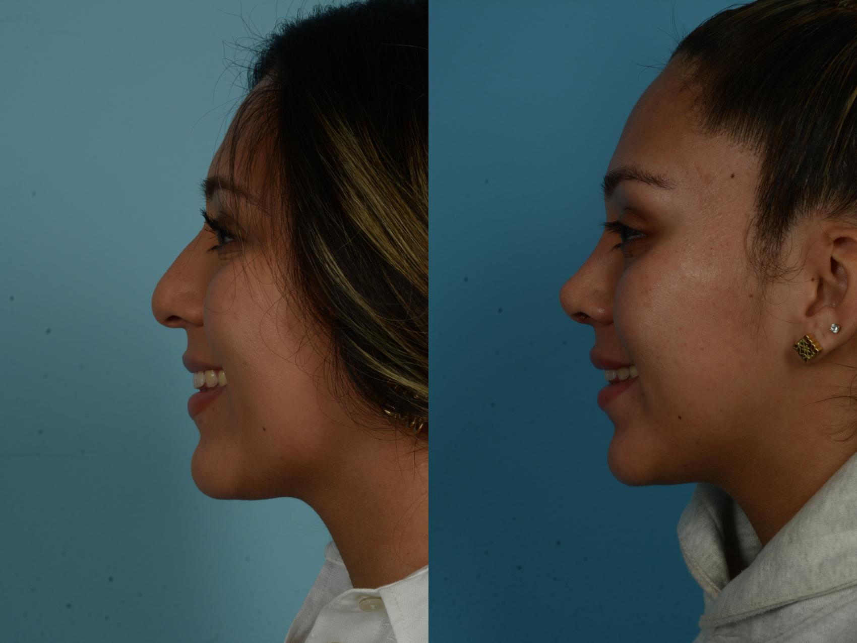 Before & After Rhinoplasty by Dr. Sinno Case 1027 Left Side View in Chicago, IL