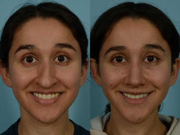 Before & After Rhinoplasty by Dr. Sinno Case 1028 Front View in Chicago, IL