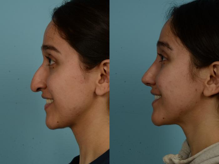 Before & After Rhinoplasty by Dr. Sinno Case 1028 Left Side View in Chicago, IL